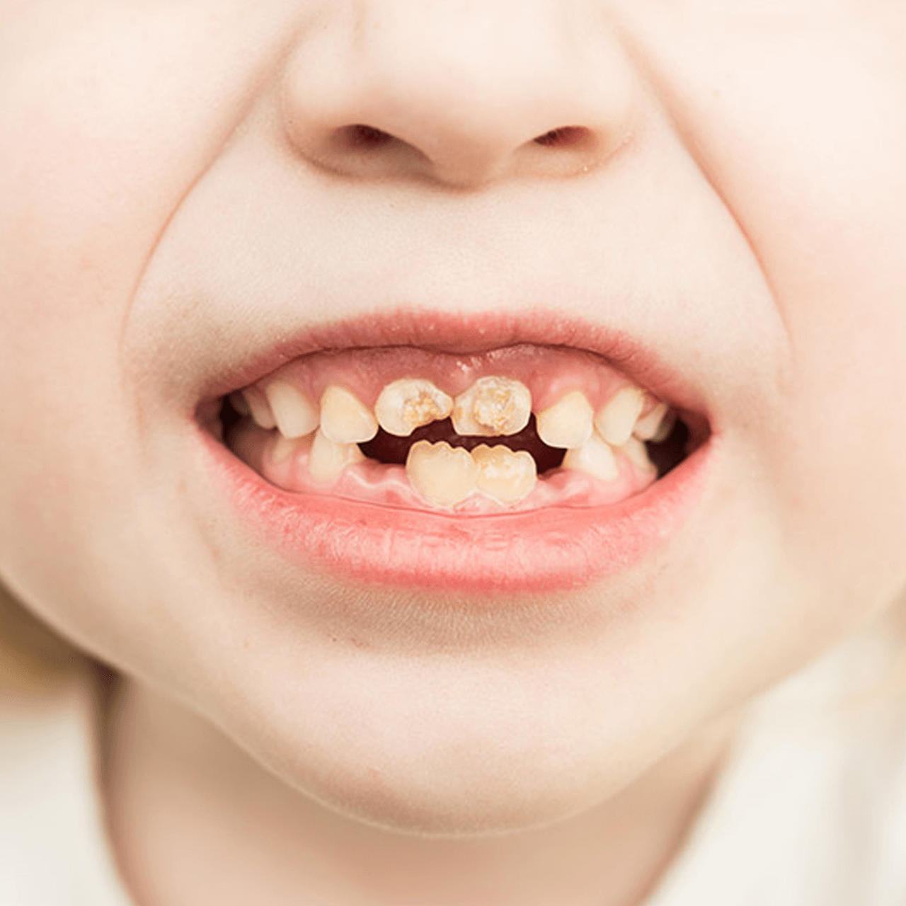 https://www.brightondc.com/wp-content/uploads/2023/08/Baby-Bottle-Tooth-Decay.png