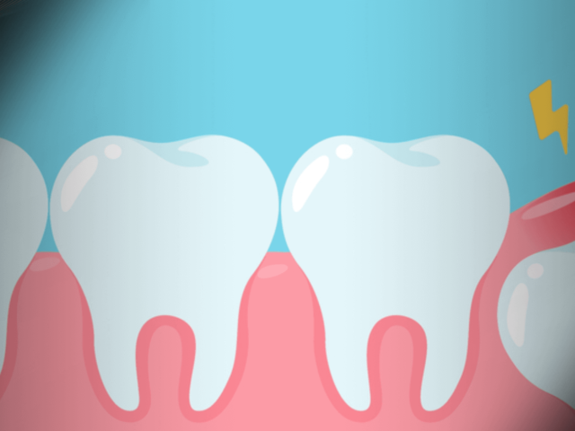 Understanding Wisdom Teeth: Do You Need Them Removed